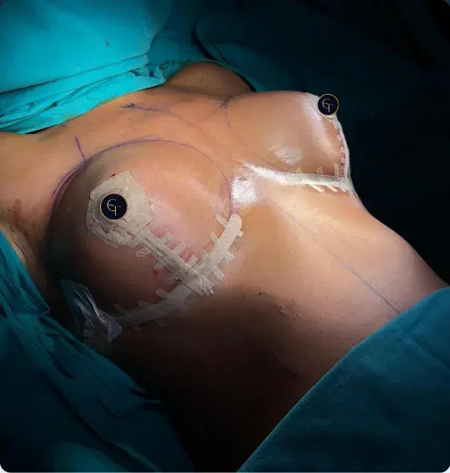 Breast lift with implants patient, front view, after