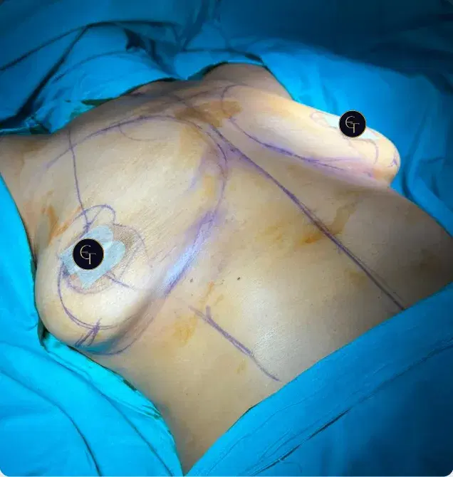 Breast lift with implants patient, front view, before